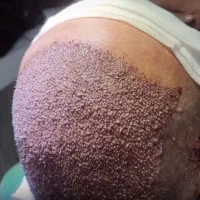 کاشت مو اقساطی