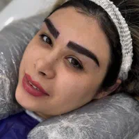 کاشت ابرو و مو