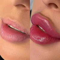تزریق فیلر و بوتاکس در کلینیک پوست و لیزر سهرابی