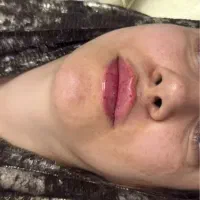 فیلر بوتاکس وایتکس پوست چشم گربه ای