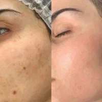پیلینگ کربن ، لیزر موی زاید