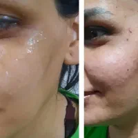 ژل لب گونه و کات گونه و بوتاکس.پیشانی دورچشم