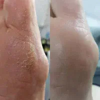 پدبکوروکفسابی