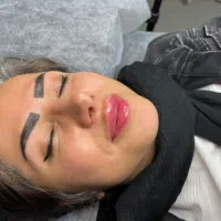 ژل بوتاکس مدل فول فی