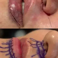 اندولیفت جراحی لیفت شقیقه گونه ابروچشم مینی بلفارو|خدمات زیبایی و سلامت|تهران, بلوار کشاورز|دیوار