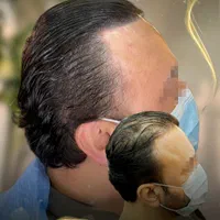 میکرواسکالپ / اسکالپ تخصصی سر/ جایگزین کاشت مو|خدمات آرایشگری و زیبایی|مشهد, وکیل‌آباد|دیوار