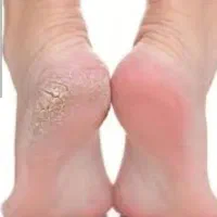 کرم ترک دست و پا