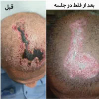 کلینیک زخم دیابتی سوختگی عفونی بستر اسکار کاشت مو