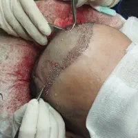 کاشت مو و ابرو|خدمات آرایشگری و زیبایی|سراب, |دیوار