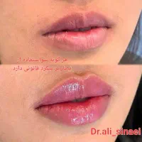 جشنواره تزریق فیلر و ژل و بوتاکس در قلب پزشکی مشهد