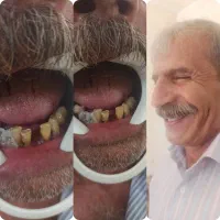 جایگزین ایمپلنت|خدمات آرایشگری و زیبایی|یزدان شهر, |دیوار