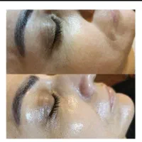فیشال پاکسازی تخصصی پوست ، آموزش فیشال