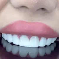 لمینت/روکش/عصبکشی/جرمگیری/کشیدن دندان