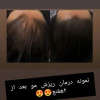 درماان ریشه ای ریزش مو