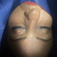 رینوپلاستی ۲۵میلیون|خدمات آرایشگری و زیبایی|قرچک, زیبا شهر|دیوار