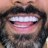 کامپوزیت دندان فقط فقط ۱/۹۰۰