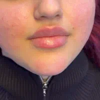 تزریق ژل لب .چانه.کات گونه.خط خنده