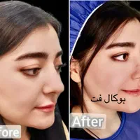 بوتاکس صورت ومعده ژل تزریق چربی عمل پلک ساکشن غبغب|خدمات آرایشگری و زیبایی|یزد, |دیوار