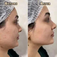 مدرن ترین روش زیبایی لیفت  زاویه ساز