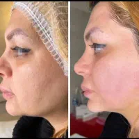 جراح زنان لابیا پلاستی تنگی ترمیم هموروئید هایفو