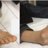 درمان در رفتگی مفاصل بدون عمل جراحی