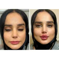 معماری صورت با فیلر/بوتاکس/پی ارپی/سلول های بنیادی|خدمات آرایشگری و زیبایی|تبریز, |دیوار