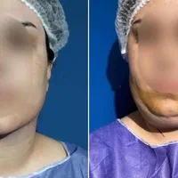ساکشن غبغب/شکم پهلو/۳۶۰درجه/با دستگاه پال|خدمات آرایشگری و زیبایی|اسلام‌شهر, شهرک مفیدی|دیوار
