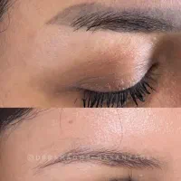 ریموو تتو ابرو و خالکوبی بدن با لیزر توسط پزشک رشت