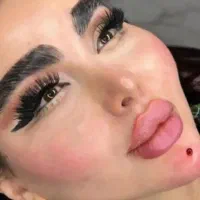 آف فیلر صورت، بوتاکس و پی آر پی توسط پزشک