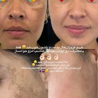 ژل بوتاکس مزوتراپی جوانساز فشیال پاکسازی|خدمات آرایشگری و زیبایی|اندیشه, اندیشه فاز ۱|دیوار