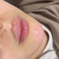 اموزش خدمات ژل بوتاکس مزوتراپی پلکسرهمراه مدرک