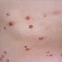 رفع قطعی و بدون بازگشت زگیل و تبخال تناسلی
