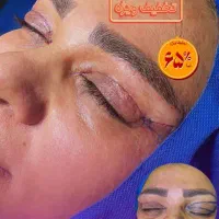 جشنواره ویژه بلفاروپلاستی(جراحی زیبایی پلک)