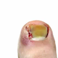 در آوردن ناخن از گوشت و بخیه و برداشتن جراحی توده