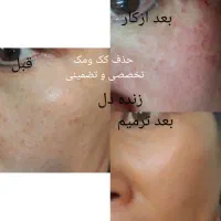 پلکسر پلاسما خالبرداری مزونیدلینگ مزو آموزش|خدمات آرایشگری و زیبایی|زاهدان, |دیوار