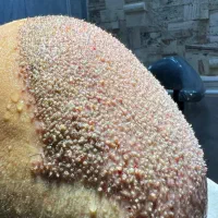 کاشت مو با کیفیت عالی