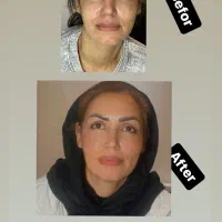 آف تزریق ژل وبوتاکس ومزوژل جوانساز|خدمات آرایشگری و زیبایی|آمل, |دیوار