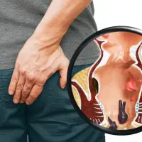 درمان بواسیر به روش نوین