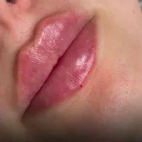 جشنواره پاییزی تخفیف ژل و بوتاکس توسط پزشک