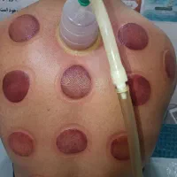 حجامت زالو فصد|آرایشی، بهداشتی، درمانی|یاسوج, |دیوار