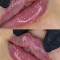 تزریق ژل و بوتاکس