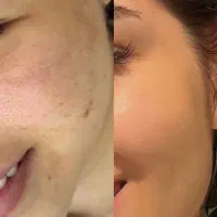 کرم لایه بردار روشن کننده لیفت کننده|آرایشی، بهداشتی، درمانی|مشهد, فدک|دیوار