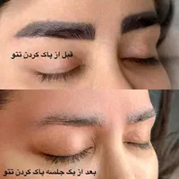 پاک کردن انواع تاتو صورت در یک جلسه