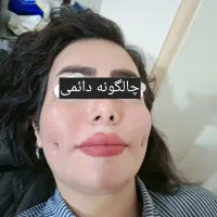 بوتاکس ژل نخ چالگونه مزو انزیم فیلر|خدمات آرایشگری و زیبایی|تبریز, |دیوار