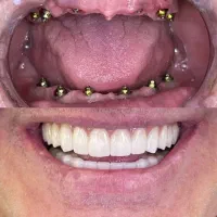 ایمپلنت کره ای درجه یک فقط ۸ میلیون، اقساطی