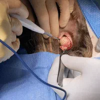 خالبرداری لیپوم منگوله تگ زگیل میخچه توسط پزشک|خدمات آرایشگری و زیبایی|تهران, شهرک غرب|دیوار