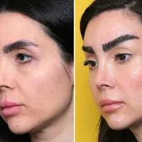 بلفاروپلاستی لیفت شقیقه بوکال فت ساکشن غبغب|خدمات آرایشگری و زیبایی|کرمانشاه, |دیوار