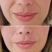 مدل هایفو و تزریق (جهت اصلاح خط خنده)|خدمات آرایشگری و زیبایی|اصفهان, دانشگاه اصفهان|دیوار