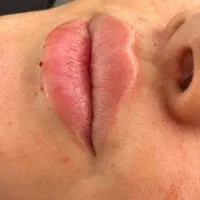 کاشت مو و کاشت ابرو وتزریق ژل و بوتاکس و مزو|خدمات آرایشگری و زیبایی|بهبهان, |دیوار