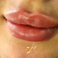 ژل و بوتاکس